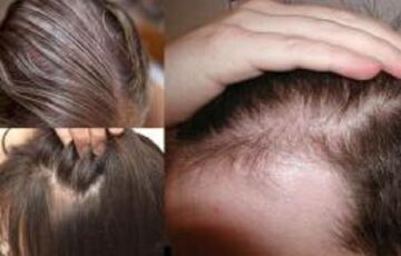 العناية بالشعر الخفيف وعلاج تساقط الشعر طرق تطويل الشعر بسرعة في أسبوع واحد فقط